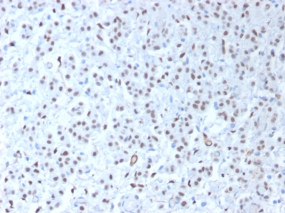FFPE human mesothelioma sections stained with 100 ul anti-Wilms Tumor 1 (clone WT1/1434R) at 1:200. HIER epitope retrieval prior to staining was performed in 10mM Citrate, pH 6.0.